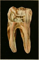 An illustration from Atlas and text-book of dentistry including diseases of the mouth / by Gustav Preiswerk. Edited by George W. Warren. (1906)