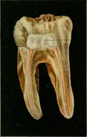 An illustration from Atlas and text-book of dentistry including diseases of the mouth / by Gustav Preiswerk. Edited by George W. Warren. (1906)