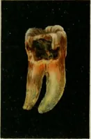 An illustration from Atlas and text-book of dentistry including diseases of the mouth / by Gustav Preiswerk. Edited by George W. Warren. (1906)