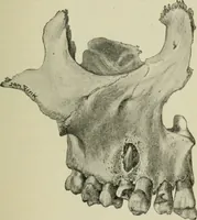An illustration from Atlas and text-book of dentistry including diseases of the mouth / by Gustav Preiswerk. Edited by George W. Warren. (1906)