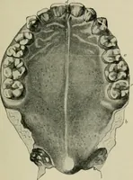 An illustration from Atlas and text-book of dentistry including diseases of the mouth / by Gustav Preiswerk. Edited by George W. Warren. (1906)