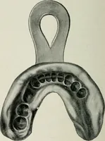 An illustration from Atlas and text-book of dentistry including diseases of the mouth / by Gustav Preiswerk. Edited by George W. Warren. (1906)
