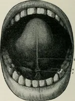 An illustration from Atlas and text-book of dentistry including diseases of the mouth / by Gustav Preiswerk. Edited by George W. Warren. (1906)