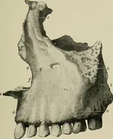 An illustration from Atlas and text-book of dentistry including diseases of the mouth / by Gustav Preiswerk. Edited by George W. Warren. (1906)