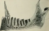 An illustration from Atlas and text-book of dentistry including diseases of the mouth / by Gustav Preiswerk. Edited by George W. Warren. (1906)