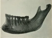 An illustration from Atlas and text-book of dentistry including diseases of the mouth / by Gustav Preiswerk. Edited by George W. Warren. (1906)