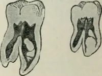 An illustration from Atlas and text-book of dentistry including diseases of the mouth / by Gustav Preiswerk. Edited by George W. Warren. (1906)