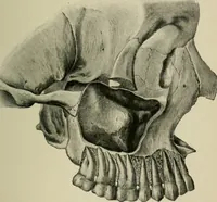 An illustration from Atlas and text-book of dentistry including diseases of the mouth / by Gustav Preiswerk. Edited by George W. Warren. (1906)