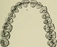 An illustration from Atlas and text-book of dentistry including diseases of the mouth / by Gustav Preiswerk. Edited by George W. Warren. (1906)