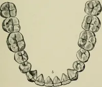 An illustration from Atlas and text-book of dentistry including diseases of the mouth / by Gustav Preiswerk. Edited by George W. Warren. (1906)