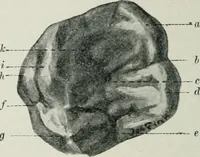 An illustration from Atlas and text-book of dentistry including diseases of the mouth / by Gustav Preiswerk. Edited by George W. Warren. (1906)