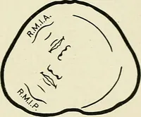 Picture 85 of 231 from Obstetrics : a text-book for the use of students and practitioners / by J. Whitridge Williams ... with eight coloured plates and six hundred and thirty illustrations in the text. (1903), leaf 225