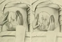 Picture 92 of 231 from Obstetrics : a text-book for the use of students and practitioners / by J. Whitridge Williams ... with eight coloured plates and six hundred and thirty illustrations in the text. (1903), leaf 273