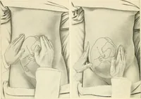Picture 97 of 231 from Obstetrics : a text-book for the use of students and practitioners / by J. Whitridge Williams ... with eight coloured plates and six hundred and thirty illustrations in the text. (1903), leaf 286