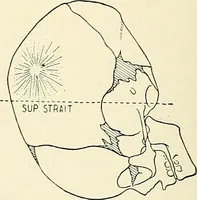 Picture 105 of 231 from Obstetrics : a text-book for the use of students and practitioners / by J. Whitridge Williams ... with eight coloured plates and six hundred and thirty illustrations in the text. (1903), leaf 302