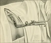 Picture 124 of 231 from Obstetrics : a text-book for the use of students and practitioners / by J. Whitridge Williams ... with eight coloured plates and six hundred and thirty illustrations in the text. (1903), leaf 420