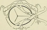 Picture 130 of 231 from Obstetrics : a text-book for the use of students and practitioners / by J. Whitridge Williams ... with eight coloured plates and six hundred and thirty illustrations in the text. (1903), leaf 423