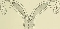 Picture 145 of 231 from Obstetrics : a text-book for the use of students and practitioners / by J. Whitridge Williams ... with eight coloured plates and six hundred and thirty illustrations in the text. (1903), leaf 521