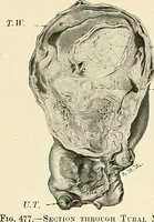 An illustration from Obstetrics : a text-book for the use of students and practitioners / by J. Whitridge Williams ... with eight coloured plates and six hundred and thirty illustrations in the text. (1903)