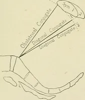 Picture 172 of 231 from Obstetrics : a text-book for the use of students and practitioners / by J. Whitridge Williams ... with eight coloured plates and six hundred and thirty illustrations in the text. (1903), leaf 643