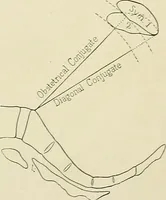 Picture 173 of 231 from Obstetrics : a text-book for the use of students and practitioners / by J. Whitridge Williams ... with eight coloured plates and six hundred and thirty illustrations in the text. (1903), leaf 643