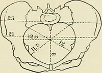 Picture 185 of 231 from Obstetrics : a text-book for the use of students and practitioners / by J. Whitridge Williams ... with eight coloured plates and six hundred and thirty illustrations in the text. (1903), leaf 661