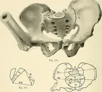 Picture 217 of 231 from Obstetrics : a text-book for the use of students and practitioners / by J. Whitridge Williams ... with eight coloured plates and six hundred and thirty illustrations in the text. (1903), leaf 726