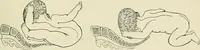 Picture 221 of 231 from Obstetrics : a text-book for the use of students and practitioners / by J. Whitridge Williams ... with eight coloured plates and six hundred and thirty illustrations in the text. (1903), leaf 745