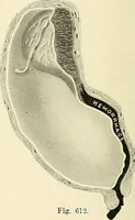 Picture 226 of 231 from Obstetrics : a text-book for the use of students and practitioners / by J. Whitridge Williams ... with eight coloured plates and six hundred and thirty illustrations in the text. (1903), leaf 770