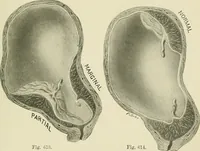 Picture 227 of 231 from Obstetrics : a text-book for the use of students and practitioners / by J. Whitridge Williams ... with eight coloured plates and six hundred and thirty illustrations in the text. (1903), leaf 773