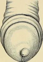 Picture 18 of 58 from A practical treatise on genito-urinary and venereal diseases and syphilis / By Robert W. Taylor. (1904), leaf 140