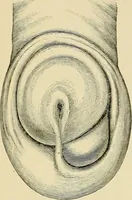 An illustration from A practical treatise on genito-urinary and venereal diseases and syphilis / By Robert W. Taylor. (1904)