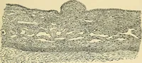 An illustration from A practical treatise on genito-urinary and venereal diseases and syphilis / By Robert W. Taylor. (1904)