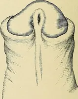 An illustration from A practical treatise on genito-urinary and venereal diseases and syphilis / By Robert W. Taylor. (1904)