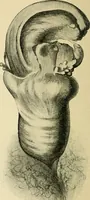 An illustration from A practical treatise on genito-urinary and venereal diseases and syphilis / By Robert W. Taylor. (1904)