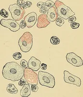 An illustration from A practical treatise on genito-urinary and venereal diseases and syphilis / By Robert W. Taylor. (1904)