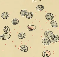 An illustration from A practical treatise on genito-urinary and venereal diseases and syphilis / By Robert W. Taylor. (1904)