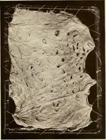 Picture 26 of 58 from A practical treatise on genito-urinary and venereal diseases and syphilis / By Robert W. Taylor. (1904), leaf 327