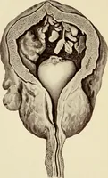 Picture 27 of 58 from A practical treatise on genito-urinary and venereal diseases and syphilis / By Robert W. Taylor. (1904), leaf 332
