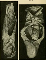 Picture 29 of 58 from A practical treatise on genito-urinary and venereal diseases and syphilis / By Robert W. Taylor. (1904), leaf 362