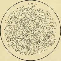 An illustration from A practical treatise on genito-urinary and venereal diseases and syphilis / By Robert W. Taylor. (1904)