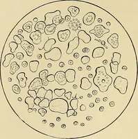 An illustration from A practical treatise on genito-urinary and venereal diseases and syphilis / By Robert W. Taylor. (1904)