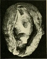 An illustration from A practical treatise on genito-urinary and venereal diseases and syphilis / By Robert W. Taylor. (1904)