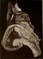 An illustration from A practical treatise on genito-urinary and venereal diseases and syphilis / By Robert W. Taylor. (1904)