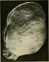An illustration from A practical treatise on genito-urinary and venereal diseases and syphilis / By Robert W. Taylor. (1904)