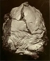 An illustration from A practical treatise on genito-urinary and venereal diseases and syphilis / By Robert W. Taylor. (1904)