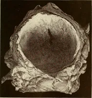 An illustration from A practical treatise on genito-urinary and venereal diseases and syphilis / By Robert W. Taylor. (1904)
