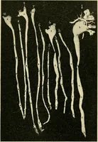 An illustration from A practical treatise on genito-urinary and venereal diseases and syphilis / By Robert W. Taylor. (1904)