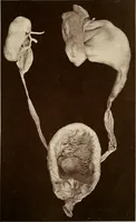An illustration from A practical treatise on genito-urinary and venereal diseases and syphilis / By Robert W. Taylor. (1904)