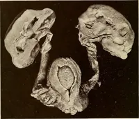 An illustration from A practical treatise on genito-urinary and venereal diseases and syphilis / By Robert W. Taylor. (1904)